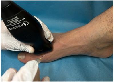 Case Report: Portable handheld ultrasound facilitates intra-articular injections in articular foot pathologies